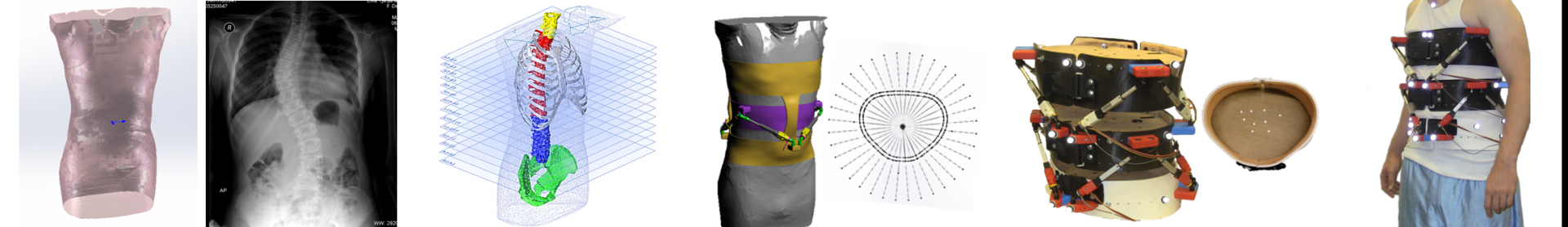 Figure illustrating the brace design process.  From left to right: a 3D scan of a body, a torso x-ray, a CAD model of the bones of the torso, a CAD model of a person wearing the brace, the fully assembled brace, and a man wearing the fully assembled brace