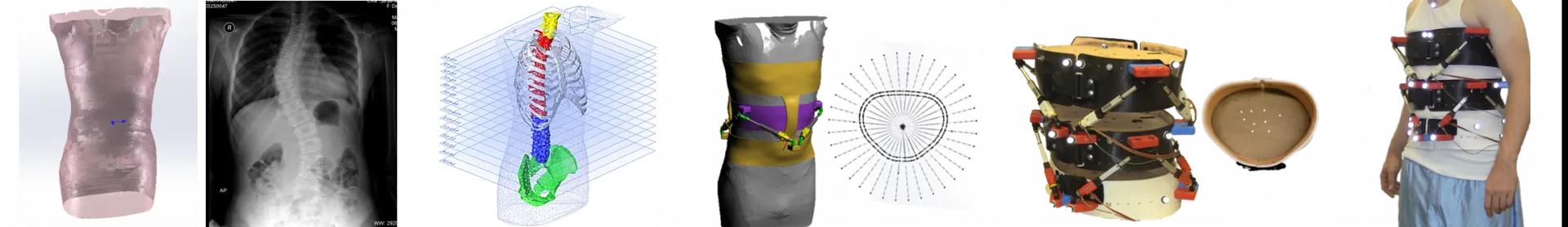 Figure illustrating the brace design process.  From left to right: a 3D scan of a body, a torso x-ray, a CAD model of the bones of the torso, a CAD model of a person wearing the brace, the fully assembled brace, and a man wearing the fully assembled brace