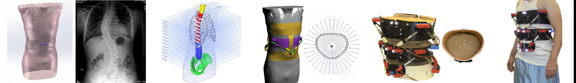 RoSE Design Process Figure illustrating the brace design process. From left to right: a 3D scan of a body, a torso x-ray, a CAD model of the bones of the torso, a CAD model of a person wearing the brace, the fully assembled brace, and a man wearing the fully assembled brace